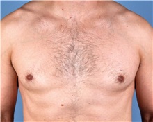 Male Breast Reduction After Photo by Thomas Hubbard, MD; Virginia Beach, VA - Case 32812