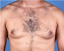 Male Breast Reduction Before Photo by Thomas Hubbard, MD; Virginia Beach, VA - Case 32812