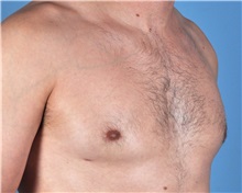 Male Breast Reduction After Photo by Thomas Hubbard, MD; Virginia Beach, VA - Case 32812