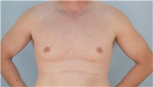 Male Breast Reduction After Photo by Thomas Hubbard, MD; Virginia Beach, VA - Case 32813