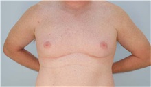 Male Breast Reduction Before Photo by Thomas Hubbard, MD; Virginia Beach, VA - Case 32813