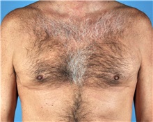 Male Breast Reduction After Photo by Thomas Hubbard, MD; Virginia Beach, VA - Case 32816