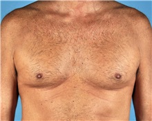 Male Breast Reduction Before Photo by Thomas Hubbard, MD; Virginia Beach, VA - Case 32816