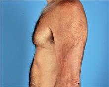 Male Breast Reduction After Photo by Thomas Hubbard, MD; Virginia Beach, VA - Case 32816