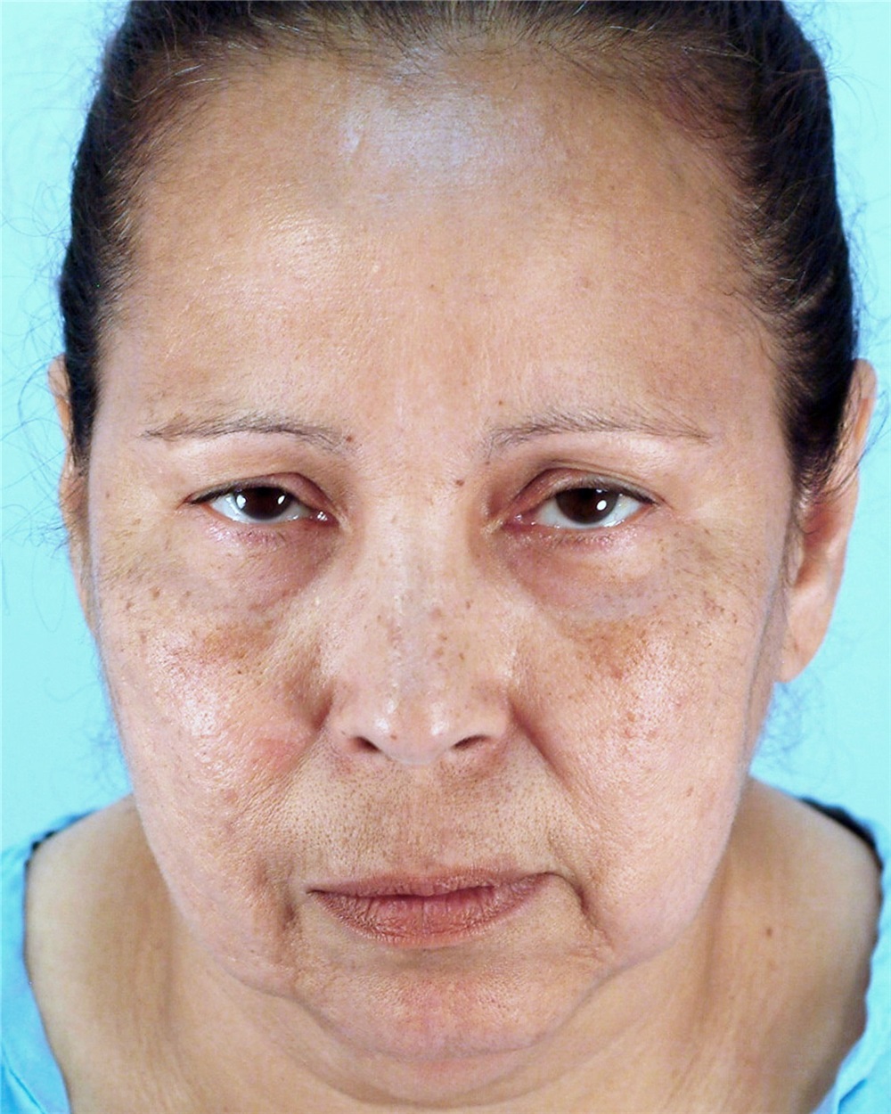 Facelift Before And After Photos By Thomas Hubbard Md Virginia Facelift Before And After Photos By