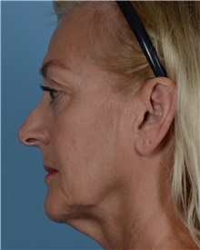 Facelift Before Photo by Thomas Hubbard, MD; Virginia Beach, VA - Case 32821