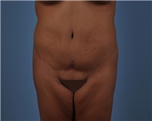 Tummy Tuck After Photo by Thomas Hubbard, MD; Virginia Beach, VA - Case 33080