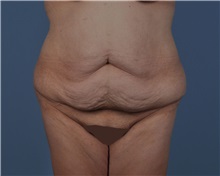 Tummy Tuck Before Photo by Thomas Hubbard, MD; Virginia Beach, VA - Case 33080