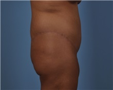 Tummy Tuck After Photo by Thomas Hubbard, MD; Virginia Beach, VA - Case 33080