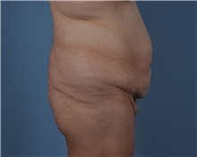 Tummy Tuck Before Photo by Thomas Hubbard, MD; Virginia Beach, VA - Case 33080