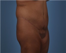 Tummy Tuck After Photo by Thomas Hubbard, MD; Virginia Beach, VA - Case 33080