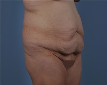 Tummy Tuck Before Photo by Thomas Hubbard, MD; Virginia Beach, VA - Case 33080
