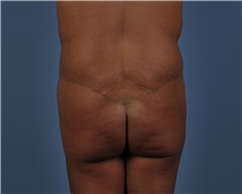 Tummy Tuck After Photo by Thomas Hubbard, MD; Virginia Beach, VA - Case 33080