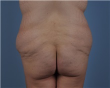 Tummy Tuck Before Photo by Thomas Hubbard, MD; Virginia Beach, VA - Case 33080