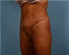 Tummy Tuck After Photo by Thomas Hubbard, MD; Virginia Beach, VA - Case 33081