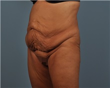 Tummy Tuck Before Photo by Thomas Hubbard, MD; Virginia Beach, VA - Case 33081