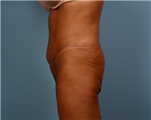 Tummy Tuck After Photo by Thomas Hubbard, MD; Virginia Beach, VA - Case 33081
