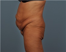 Tummy Tuck Before Photo by Thomas Hubbard, MD; Virginia Beach, VA - Case 33081