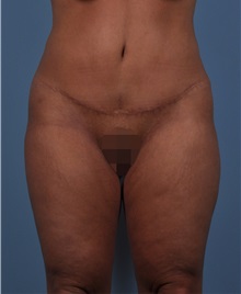 Tummy Tuck After Photo by Thomas Hubbard, MD; Virginia Beach, VA - Case 33094