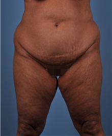 Tummy Tuck Before Photo by Thomas Hubbard, MD; Virginia Beach, VA - Case 33094
