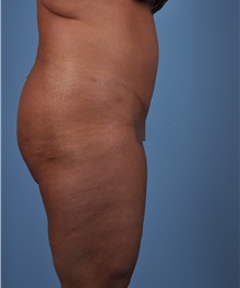 Tummy Tuck After Photo by Thomas Hubbard, MD; Virginia Beach, VA - Case 33094