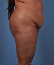 Tummy Tuck Before Photo by Thomas Hubbard, MD; Virginia Beach, VA - Case 33094