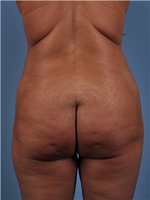 Tummy Tuck After Photo by Thomas Hubbard, MD; Virginia Beach, VA - Case 33094