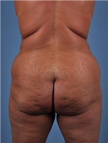 Tummy Tuck Before Photo by Thomas Hubbard, MD; Virginia Beach, VA - Case 33094