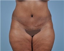 Tummy Tuck After Photo by Thomas Hubbard, MD; Virginia Beach, VA - Case 33550