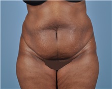 Tummy Tuck Before Photo by Thomas Hubbard, MD; Virginia Beach, VA - Case 33550