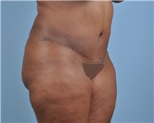 Tummy Tuck After Photo by Thomas Hubbard, MD; Virginia Beach, VA - Case 33550