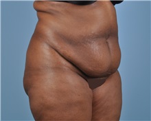 Tummy Tuck Before Photo by Thomas Hubbard, MD; Virginia Beach, VA - Case 33550