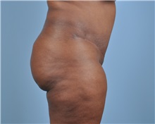 Tummy Tuck After Photo by Thomas Hubbard, MD; Virginia Beach, VA - Case 33550