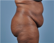 Tummy Tuck Before Photo by Thomas Hubbard, MD; Virginia Beach, VA - Case 33550