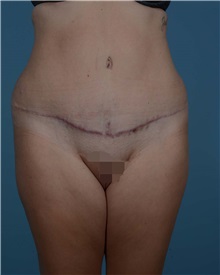 Tummy Tuck After Photo by Thomas Hubbard, MD; Virginia Beach, VA - Case 33551