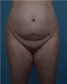 Tummy Tuck Before Photo by Thomas Hubbard, MD; Virginia Beach, VA - Case 33551