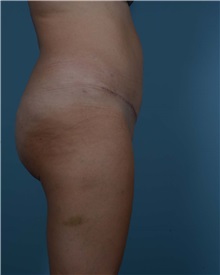 Tummy Tuck After Photo by Thomas Hubbard, MD; Virginia Beach, VA - Case 33551