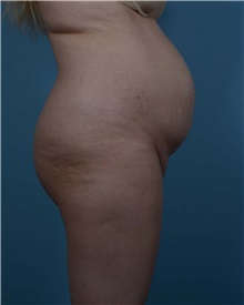 Tummy Tuck Before Photo by Thomas Hubbard, MD; Virginia Beach, VA - Case 33551