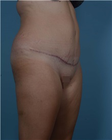 Tummy Tuck After Photo by Thomas Hubbard, MD; Virginia Beach, VA - Case 33551