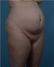 Tummy Tuck Before Photo by Thomas Hubbard, MD; Virginia Beach, VA - Case 33551