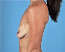 Breast Lift Before Photo by Thomas Hubbard, MD; Virginia Beach, VA - Case 33553