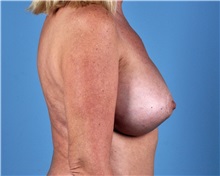 Breast Lift After Photo by Thomas Hubbard, MD; Virginia Beach, VA - Case 33554