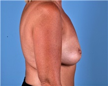 Breast Lift Before Photo by Thomas Hubbard, MD; Virginia Beach, VA - Case 33554