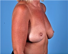 Breast Lift Before Photo by Thomas Hubbard, MD; Virginia Beach, VA - Case 33554