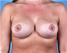 Breast Lift After Photo by Thomas Hubbard, MD; Virginia Beach, VA - Case 33557