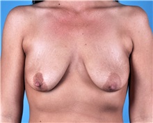 Breast Lift Before Photo by Thomas Hubbard, MD; Virginia Beach, VA - Case 33557