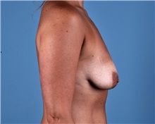 Breast Lift Before Photo by Thomas Hubbard, MD; Virginia Beach, VA - Case 33558