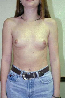 Breast Augmentation Before Photo by Randy Proffitt, MD; Mobile, AL - Case 21753