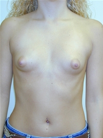 Breast Augmentation Before Photo by Randy Proffitt, MD; Mobile, AL - Case 21754