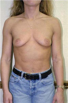 Breast Augmentation Before Photo by Randy Proffitt, MD; Mobile, AL - Case 21763